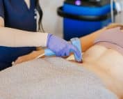 morpheus8 exploring the science of microneedling with radiofrequency bodify medical spa