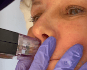 Learn how Morpheus8 smooths fine lines and rejuvenates lips and eyes for a youthful look. Trust Bodify for safe, effective treatments. Contact us to transform your skin today!