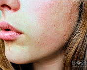 Discover how Morpheus8 transforms skin resurfacing, reducing wrinkles, scars, and uneven tone. Trust Bodify for radiant, rejuvenated skin. Start your journey today!