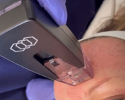 Discover the differences between Morpheus8 and laser resurfacing for skin rejuvenation. Contact Bodify MedSpa to choose the best treatment for your skincare goals.