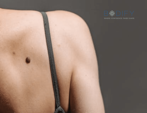 Treating Uneven Skin Texture on the Back and Shoulders with Morpheus8 in Phoenix